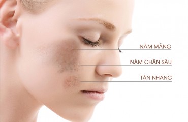 ĐIỀU TRỊ NÁM, TÀN NHANG, BỚT SẮC TỐ
